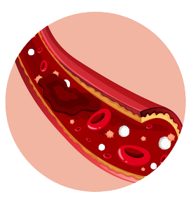 aneurisma isquemico